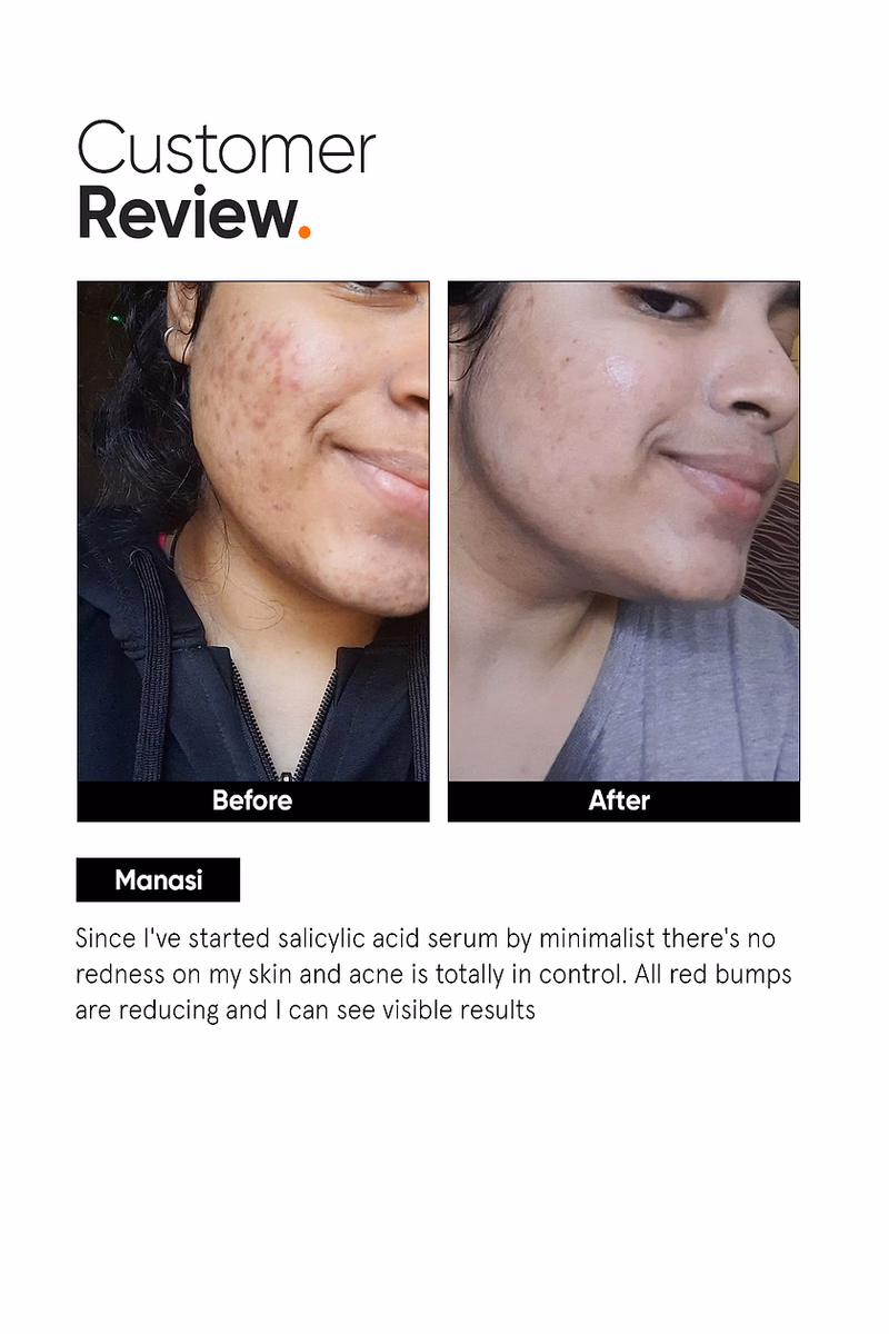 Minimalist - 2% Salicylic Acid - Face Serum - For Blackheads & Whiteheads