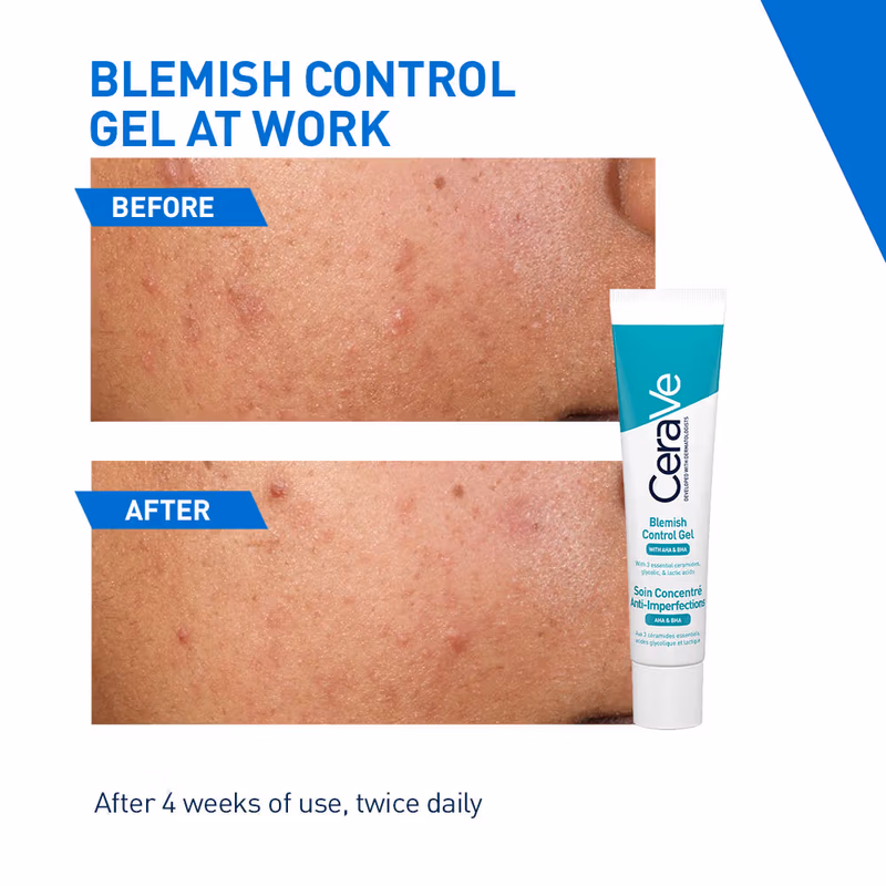 CeraVe - Blemish Control Gel - with 2% Salicylic Acid, AHA & Niacinamide for Acne Spot Treatment